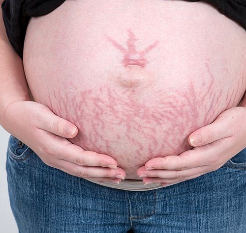 When do stretch marks start in pregnancy?