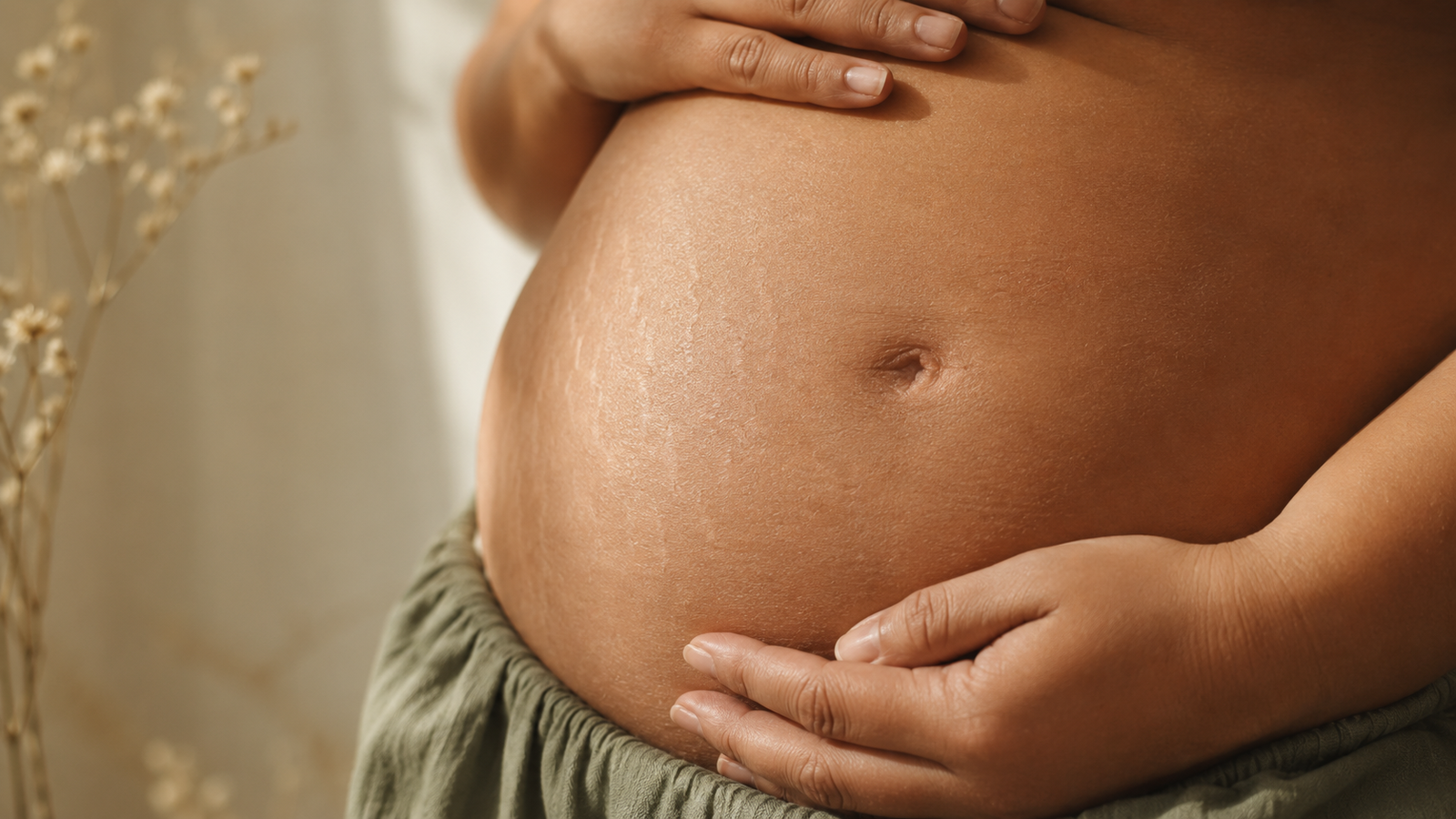 Pregnancy bump with visible stretch marks, held by two hands