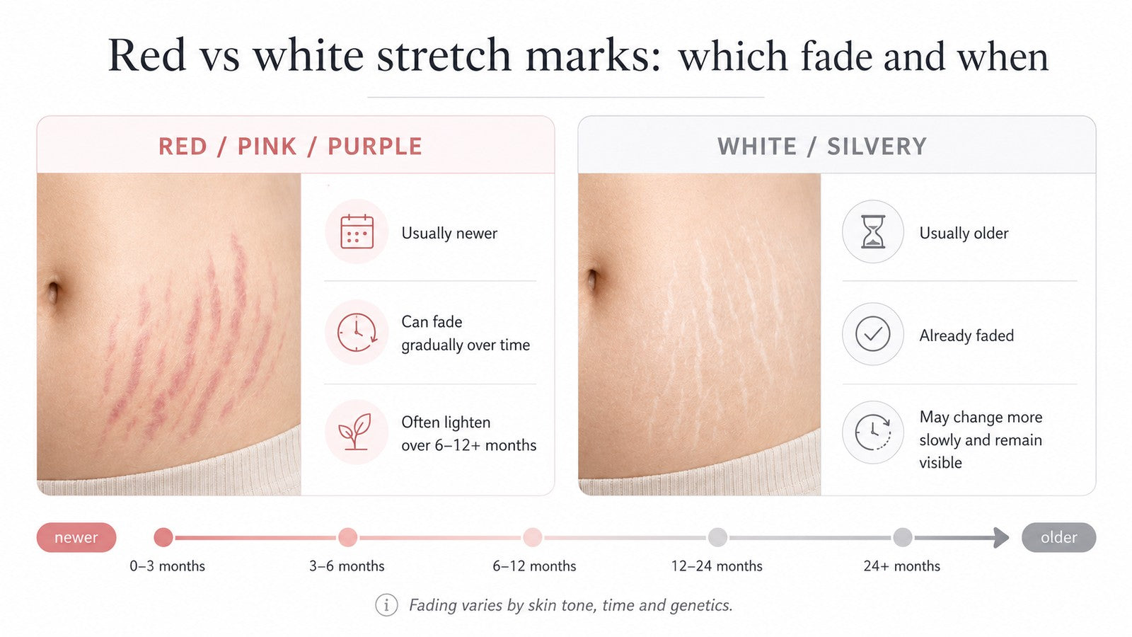 Types of Stretch Marks: Red, Purple, White & Silver Explained